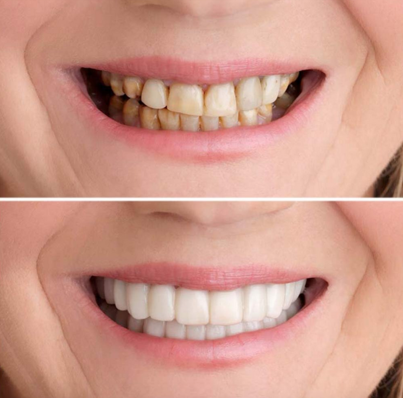 Sorriso Fácil™  - Dentes brancos superior + inferior